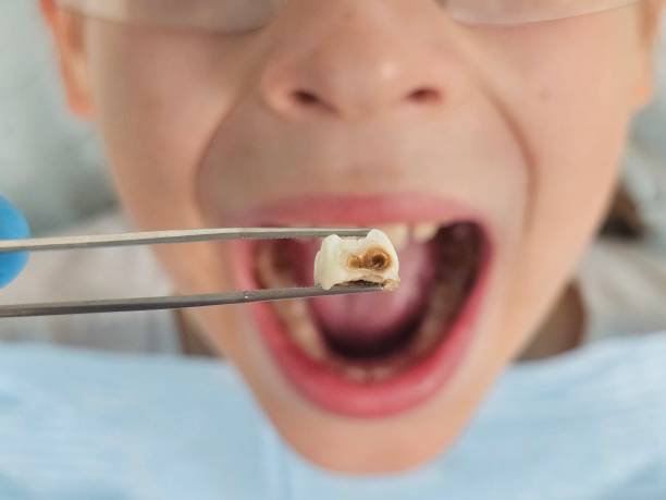 Best Urgent Care for Lost Fillings or Crowns in Walnut Creek, OH