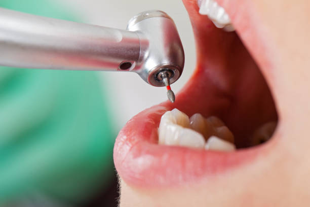 Best Emergency Dental Care for Broken or Chipped Teeth in Walnut Creek, OH